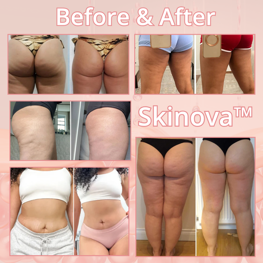 Skinova™ Ultimate Body Contour & Cellulite Treatment Massager